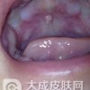 口腔白斑病的症状是有哪些