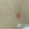一期梅毒的诊断依据是什么