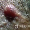 为什么一期梅毒不容易发现