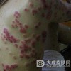 感染一期梅毒为何不可以延缓治疗