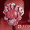 治疗尖锐湿疣的什么疗法能有效