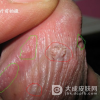 治疗了尖锐湿疣为什么还是会复发