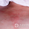 皮肌炎患者平时要注意哪些呢