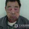 皮肌炎的日常生活调理