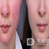 中医治疗红血丝吃什么药