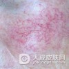 红血丝怎么消除吃什么