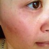 红血丝怎样的消除吃什么