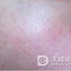 经常的上网怎样预防红血丝