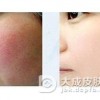 生活中如何预防红血丝吗