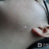 如何护理晕痣先天性色素痣
