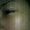 传染性红斑的诱发因素有哪些