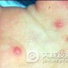 手足口病会不会传染