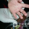 通过看口腔判断手足口病