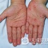 手足口病是通过什么传染的呢