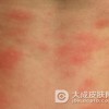 冬季如何预防皮肤过敏