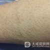 治疗鱼鳞病要讲究方法