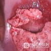 女性尖锐湿疣潜伏期有什么症状呢