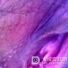 女性尖锐湿疣的初期症状有什么