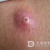 痈肿的皮损特点有哪些呢