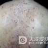 怎么预防接触性皮炎