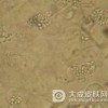 口腔念珠菌病要如何鉴别诊断呢