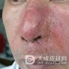 酒槽鼻有哪些症状？
