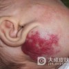 蔓状血管瘤要如何治疗最好呢