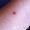 哪些原因易产生皮肤纤维瘤