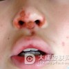 黄水疮发病多呈流行化