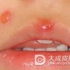 黄水疮发病的原因是什么
