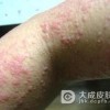 过敏性皮炎具体是怎么回事