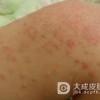 正确护理过敏性皮炎的方法