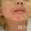 如何确定患有过敏性皮炎