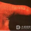类丹毒的症状都有哪些