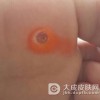 浅析鸡眼的治疗方法