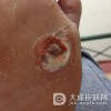 发生鸡眼有什么办法可以去除