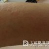 日光性皮炎怎么护理