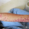 过敏性紫癜预防需要用哪些方法