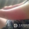 如何彻底治愈日光性皮炎