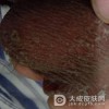 慢性阴囊湿疹有何特征