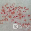 为什么非淋菌性尿道炎会反复发作