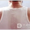关于多汗症的发病机制