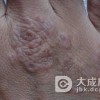 如何有效的诊断手足癣呢