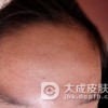 鼻头长粉刺的防治事项都有哪些