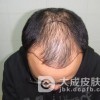 脱发暗示的疾病有哪些