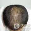 脱发严重怎么办