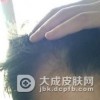 头顶脱发很严重怎么办