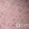 在治疗鱼鳞病期间有什么要注意的呢