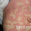 牛皮癣最新治疗的方法