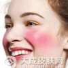 消除脸上红血丝偏方